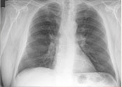 Chest X-Ray